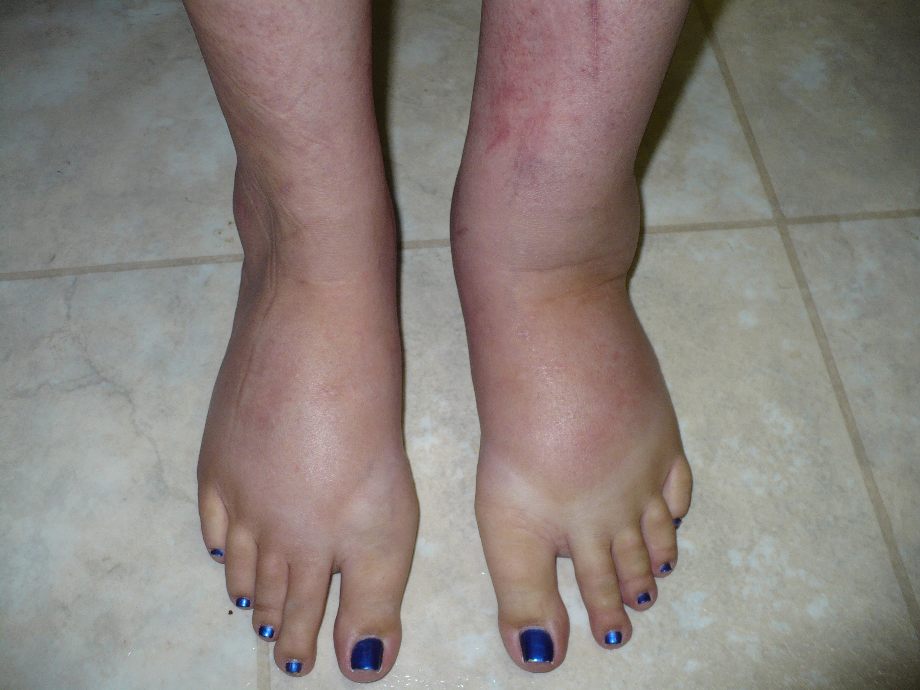 Lymphedema Treatment