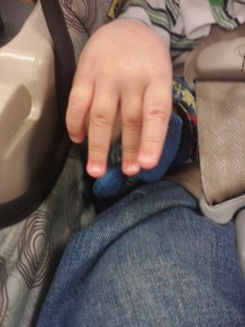 fingers of a baby with Marfan syndrome