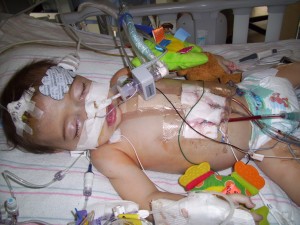 child with Marfan syndrome after heart surgery